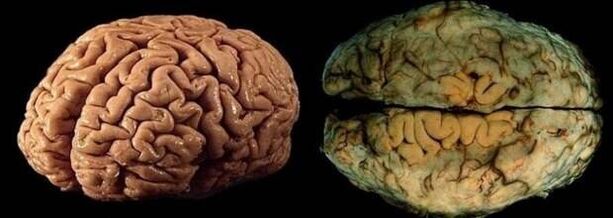 creierul unei persoane sănătoase și care bea